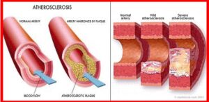 atherosclerosis, plagues, clogged arteries
