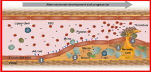 atherosclerosis, plagues, clogged arteries
