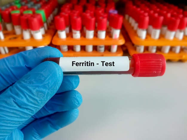 Ferritin level over 1000: Blood sample ferritin test with laboratory background for diagnosing anemia, iron overload, and high ferritin levels.