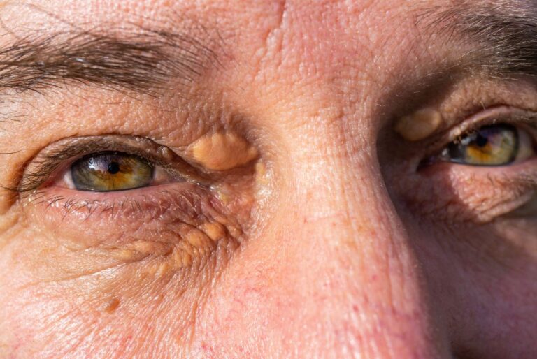 The early warning signs of high cholesterol: Close-up of yellowish xanthelasma patches around the eyes, an early visible sign of high cholesterol often seen in women.