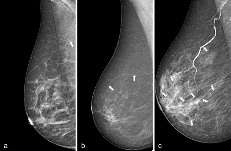 Detection and quantification of breast arterial calcification (BAC) on a screening mammogram, showing linear vascular calcifications in breast arteries linked to cardiovascular risk.