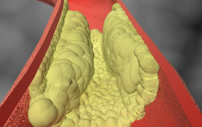 Illustration showing calcium buildup hardening artery walls, explaining the 9 main arterial calcification causes and increased heart disease risk.