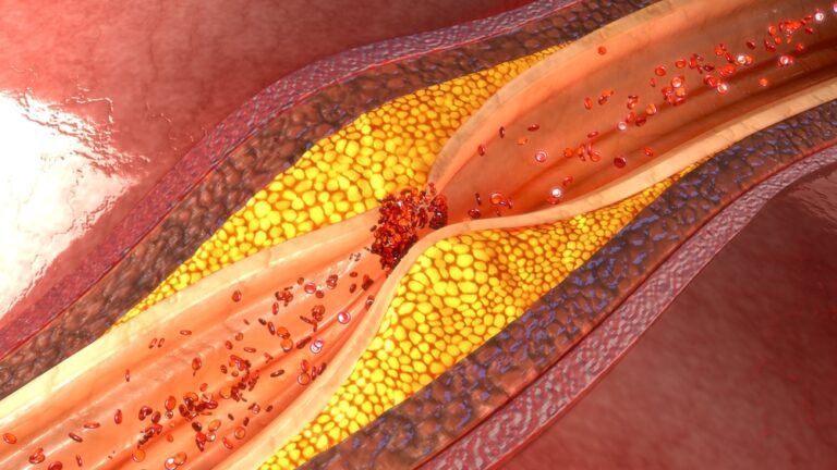 Arterial Stiffness vs Clogging: Clogged artery with plaque buildup restricting blood flow, illustrating Atherosclerosis and the difference between arterial clogging and stiffness.