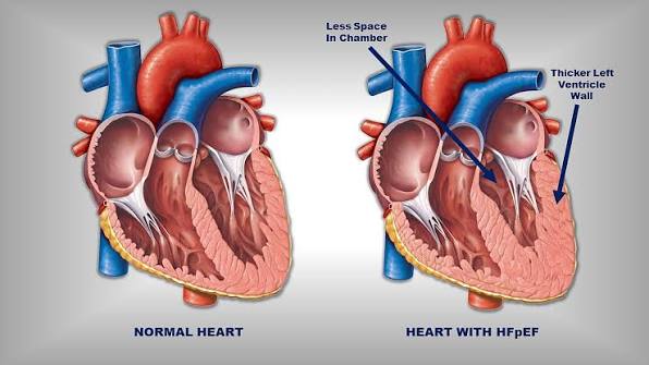 Diastolic heart failure (HFpEF) diagram comparing a normal heart with a thickened left ventricle wall and reduced chamber space — the structural cause of breathlessness and fluid buildup in HFpEF patients.