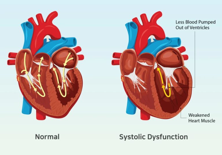 Medical diagram comparing a normal heart with strong ventricular contractions versus systolic dysfunction showing weakened heart muscle and reduced blood pumped out of the ventricles — key visual for understanding chronic systolic heart failure symptoms and causes.