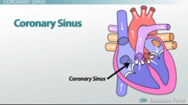 Diagram of the coronary sinus showing how it collects blood from the cardiac veins and drains into the right atrium, illustrating where coronary sinus thrombosis forms.