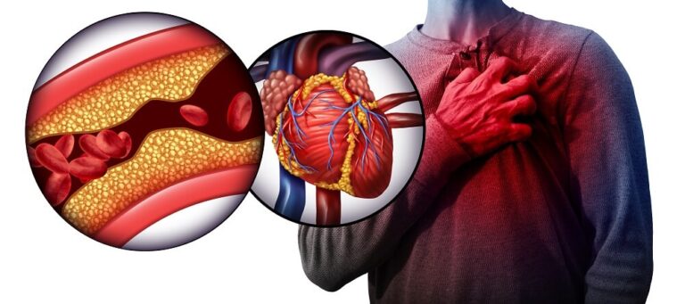 Illustration of coronary thrombosis showing plaque buildup narrowing an artery next to a blocked heart artery, with a man clutching his chest in heart attack pain, comparing coronary thrombosis vs ischemic stroke